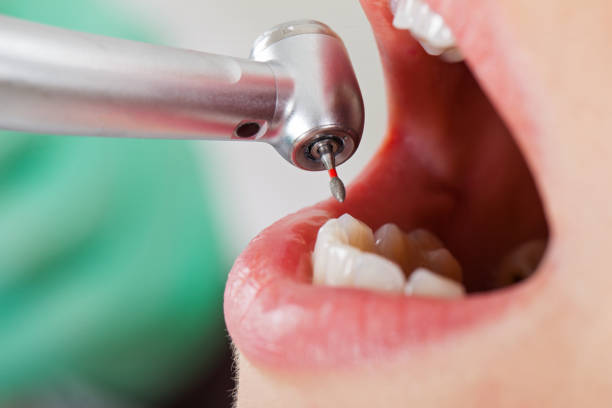 Best Emergency Treatment for Toothache in Edwards, CO